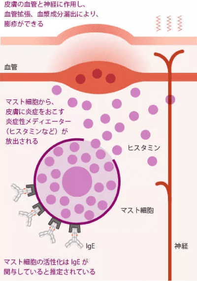 慢性蕁麻疹の病態 イメージ図